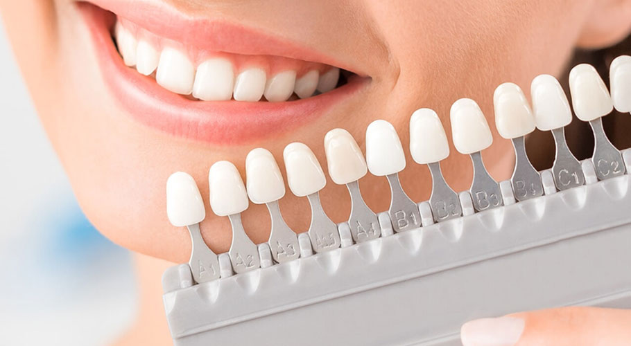 Smile design and teeth whitening