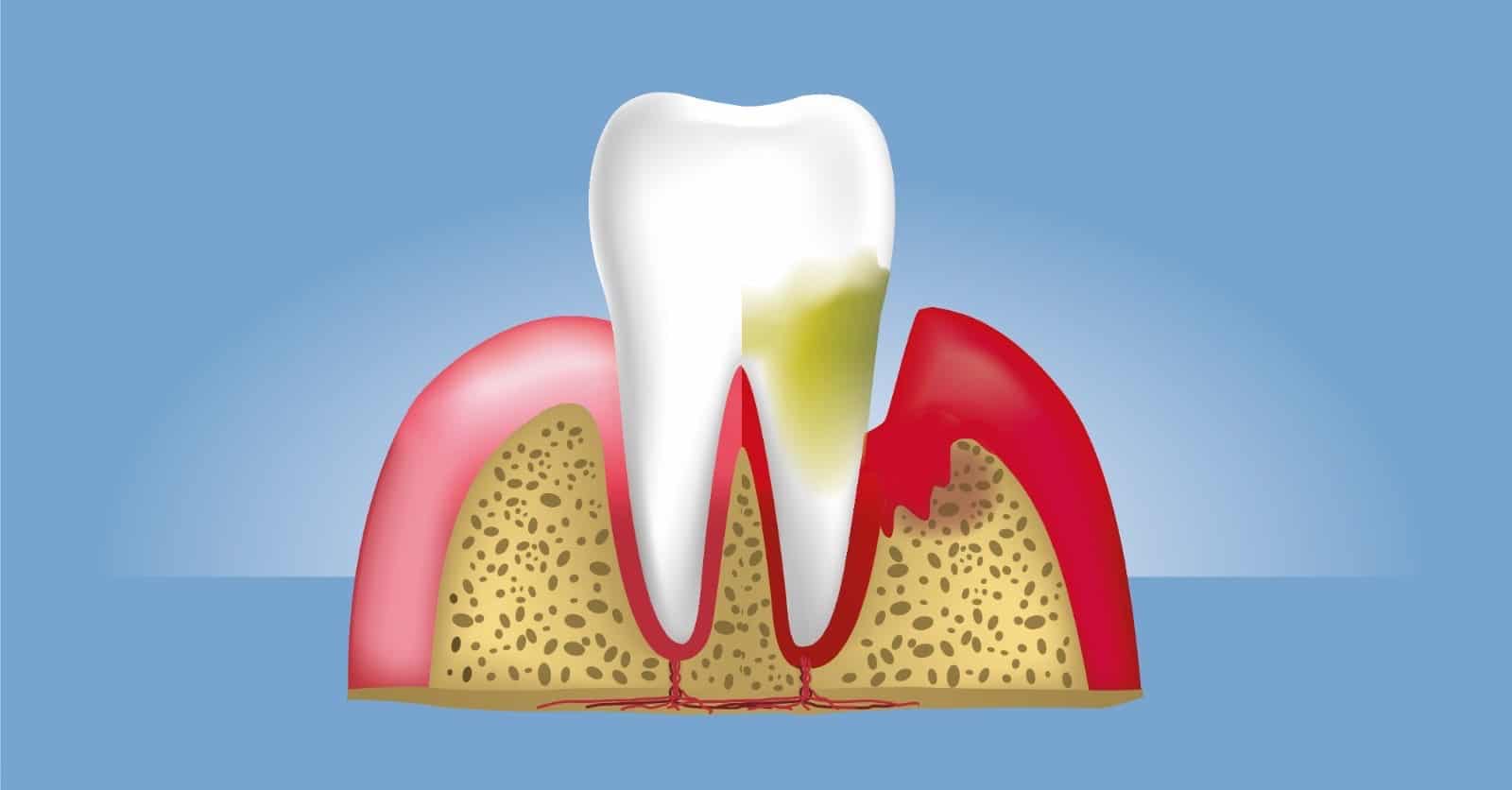 Professional dental cleaning and gum care