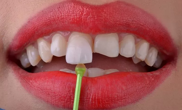 Porcelain laminate veneers smile treatment